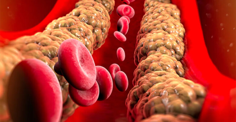 علامتان في الشعر تنذران بارتفاع الكوليسترول في الدم