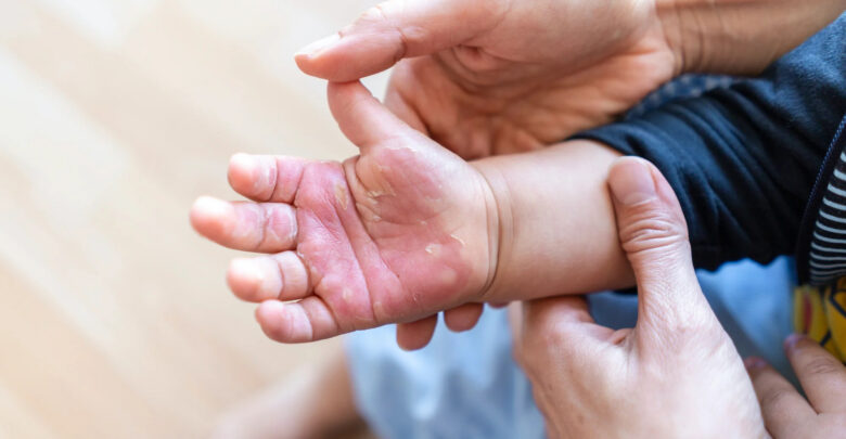 حقيقة تخفيف معجون الأسنان آلام الحروق الجلدية