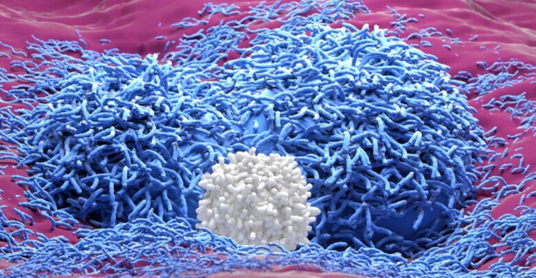 علاج واعد لسرطان الخلايا الكبدية