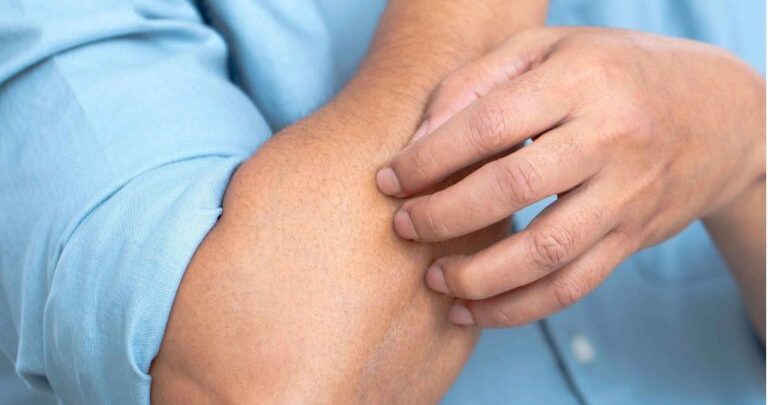 خبراء الجلدية يحذرون مرضى “التقرن الشعري” من حكّ الجلد المصاب