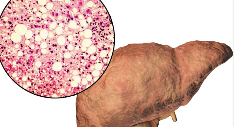 حالة مَرضية صامتة تصيب الكبد… تهدد القلب