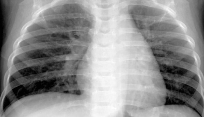 ما نعرفه عن «الميتانيوفيروس البشري» المنتشر في الصين
