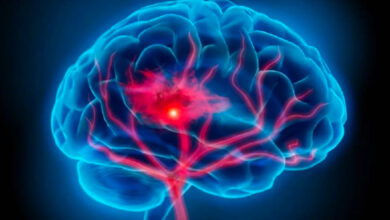 بكتيريا تزيد خطر الإصابة بالسكتة الدماغية