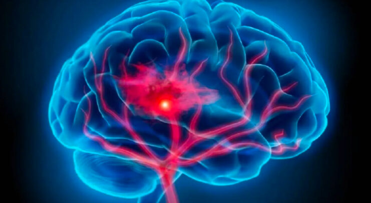 بكتيريا تزيد خطر الإصابة بالسكتة الدماغية